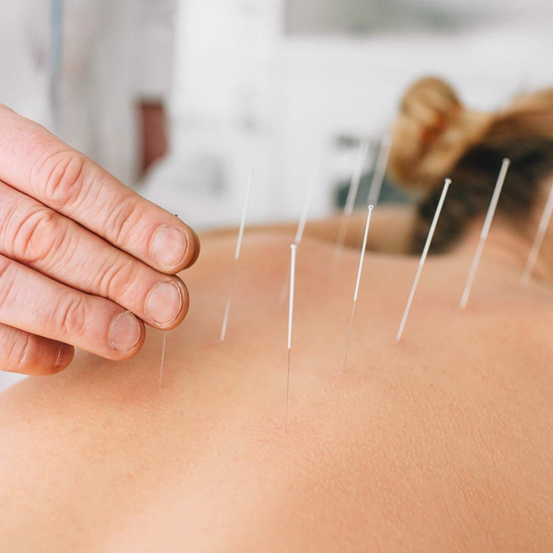 Woman having acupuncture treatment on her back