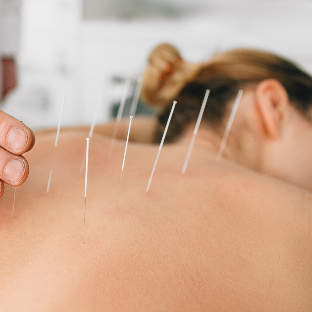 Woman having acupuncture treatment on her back