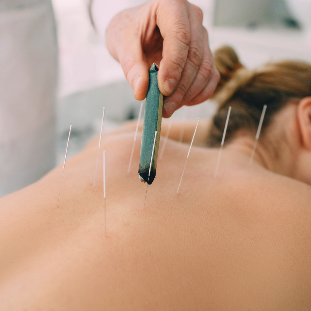 Acupuncture